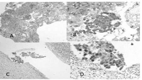 Carcinoma no clasificable: A Lesi&oacute;n hipercelular solida dividida por vasos sangu&iacute;neos de paredes delgadas escaso grupo de c&eacute;lulas epiteliales inmersas en material fibrinaceo (H-E 4X). B Un grupo de c&eacute;lulas inequ&iacute;vocas de malignidad pero insuficientes para establecer un patr&oacute;n (H-E 40X). C Muestra con abundante necrosis (H-E 4X). D Un grupo de fantasmas celulares similares a la anterior pero no es posible la aseveraci&oacute;n de malignidad (H-E 40X).
