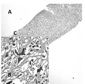 Carcinoma sarcomatoide de c&eacute;lulas gigantes: A y B Lesi&oacute;n constituida por c&eacute;lulas pleom&oacute;rficas de gran tama&ntilde;o con n&uacute;cleos bizarros (H-E 4X- 40X).