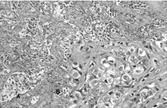 ADC patr&oacute;n s&oacute;lido: A. Lesi&oacute;n s&oacute;lida que carece de alg&uacute;n patr&oacute;n conocido, con crecimiento en s&aacute;banas (H-E 4X). B. Las c&eacute;lulas presentan n&uacute;cleo-megalia, irregularidad nuclear, nucl&eacute;olo prominente con caracter&iacute;stico citoplasma vacuolado.