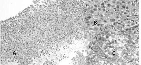 ADC patr&oacute;n s&oacute;lido: A. Lesi&oacute;n s&oacute;lida que carece de alg&uacute;n patr&oacute;n conocido, con crecimiento en s&aacute;banas (H-E 4X). B. Las c&eacute;lulas presentan n&uacute;cleo y nucl&eacute;olo prominente. (H-E 40X). C. Con la reacci&oacute;n de PAS se pone en manifiesto la mucina intracitoplasm&aacute;tica.