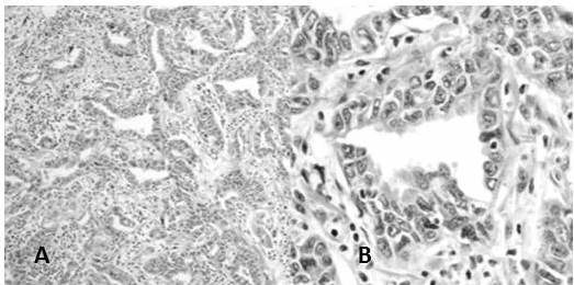 ADC patr&oacute;n acinar: A. La lesi&oacute;n crece formando estructuras glandulares (H-E 10X). B. Las c&eacute;lulas se organizan en torno a luces y presentan n&uacute;cleo-megalia, anisonucleosis y nucl&eacute;olo prominente (H-E 40X).
