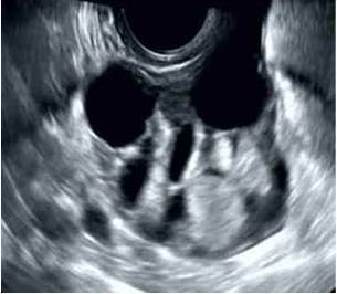 Imagen ecogr&aacute;fica que muestra tumor s&oacute;lido en ovario derecho, multilocular con cavidades qu&iacute;sticas irregulares y &aacute;rea s&oacute;lida, lisa y redondeada con proyecciones papilares.