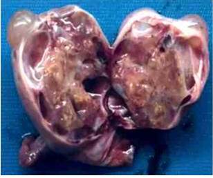 Imagen del tumor del ovario derecho.