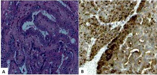Im&aacute;genes histopatol&oacute;gicas del struma ovarii. A. Fol&iacute;culos tiroideos con de diferentes tama&ntilde;os con material coloide con &aacute;reas hiperpl&aacute;sicas y arquitectura ramificada con caracter&iacute;sticas citol&oacute;gicas at&iacute;picas que incluyen superposici&oacute;n y agrandamiento de los n&uacute;cleos, compatibles con el carcinoma papilar de tiroides (coloraci&oacute;n hematoxilina-eosina). B. Inmunotinci&oacute;n positiva para tiroglobulina.