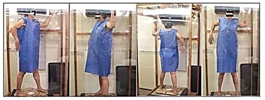 T&eacute;cnica de ICTE. Se pueden observar 4 de las 6 posiciones utilizadas para la irradiaci&oacute;n corporal total.