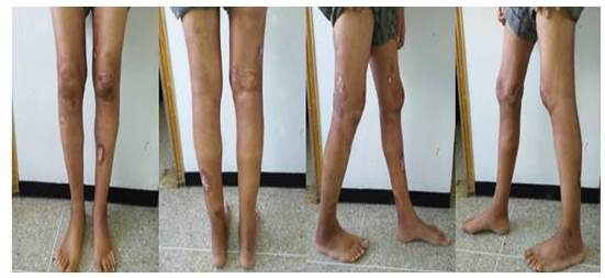 Im&aacute;genes actuales 2 a&ntilde;os despu&eacute;s de la RT