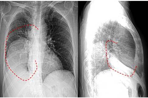 Radiograf&iacute;a de t&oacute;rax en vista anteroposterior. Se observa una imagen tumoral en el l&oacute;bulo inferior del pulm&oacute;n derecho B) Vista lateral izquierda, donde se aprecia la gran masa tumoral. (L&iacute;nea punteada roja).