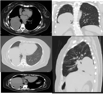 Tomograf&iacute;a axial computarizada, se observa lesi&oacute;n de tejido blando ovalada de contorno parcialmente definido con contacto pleural.