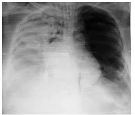 Radiograf&iacute;a de t&oacute;rax en vista anteroposterior. Atelectasia pulmonar total del pulm&oacute;n derecho producto de la compresi&oacute;n por la gran masa tumoral, as&iacute; como del material mixoide (gelatinoso) que produce este tipo de pulm&oacute;n el cual posiblemente este inundando al trato bronquial principal derecho.