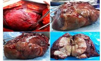 Pieza quir&uacute;rgica correspondiente a lesi&oacute;n tumoral liposarcoma mixoide de bajo grado de malignidad con un peso de 250 gr, extirpado el l&oacute;bulo inferior y medio derecho con el tumor.