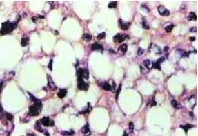 Microfotograf&iacute;a. Neoplasia de aspecto mesenquimal constituida en &aacute;reas por c&eacute;lulas fusiformes, con escaso citoplasma con n&uacute;cleos perif&eacute;ricos con ligero pleomorfismo e hipercromatismo, identados, con citoplasma con vacuolas de aspecto lipomatoso, c&eacute;lulas estrellada escasa mitosis at&iacute;pica inmersas en matriz mixoide. Con escasos lipoblastos en &ldquo;anillo de sello&rdquo;