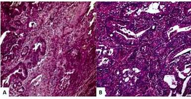 Adenocarcinoma cloacog&eacute;nico de vulva. A. C&eacute;lulas tumorales con crecimiento villoglandular en continuidad con la epidermis. B. C&eacute;lulas secretoras de mucina con algunas c&eacute;lulas caliciformes intercaladas presentes dentro del epitelio escamoso supra-yacente (Coloraci&oacute;n hematoxilina-eosina).