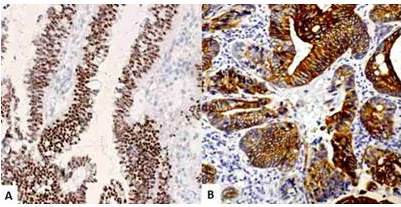 Tinci&oacute;n inmunohistoqu&iacute;mica del tumor. A. Coloraci&oacute;n puntual a citoqueratina 7. B. Coloraci&oacute;n marcada a citoqueratina 20.