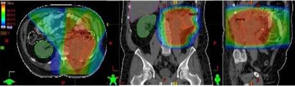 Plan de tratamiento de paciente con sarcoma retroperitoneal (leiomiosarcoma) a nivel occipital, posterior a resecci�n, donde se muestra distribuci�n porcentual de la dosis en las distintas tonalidades de colores representando el color rojo el 100 %, observ�ndose la exclusi�n total del ri��n contralateral y las asas intestinales recibiendo menor dosis.