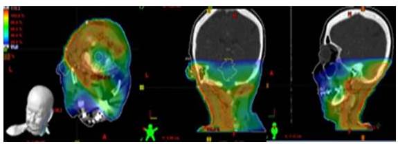 Plan de tratamiento de paciente con sarcoma de cabeza y cuello (angiosarcoma) a nivel occipital, posterior a resecci�n con m�rgenes estrechos, donde se muestra distribuci�n porcentual de la dosis en las distintas tonalidades de colores representando el color rojo el 100 %, observ�ndose que el par�nquima cerebral y m�dula espinal reciben dosis m�s bajas.