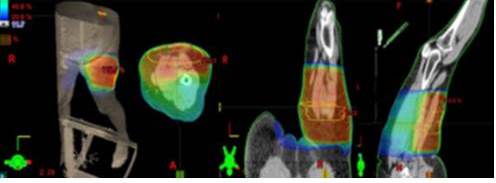 Plan de tratamiento de paciente con sarcoma de extremidad inferior izquierda (liposarcoma) a nivel femoral, posterior a resecci�n completa, se muestra distribuci�n porcentual de la dosis en las distintas tonalidades de colores representando el color rojo 100 %, observ�ndose que el f�mur recibe dosis m�s bajas.