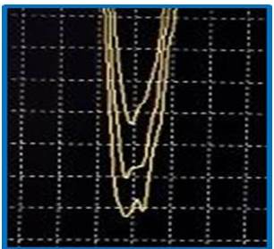 PEM del orbicular de los labios.