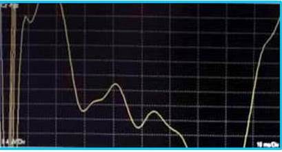 PESS tibial posterior derecho.