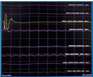 Uso de estimulador monopolar.