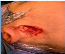 Irritacin electromiogrfica nivel del orbicular de los labios.