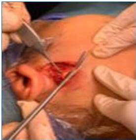 Defecto resultante luego de reseccin de tumor