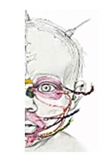 Colocacin de electrodos de aguja.