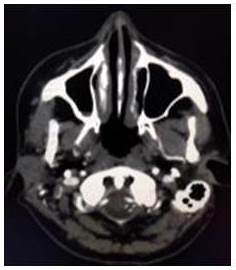 Tomografa de cuello, corte axial. Tumoracin en regin parotdea derecha.
