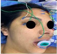 Colocacin de electrodos de aguja.