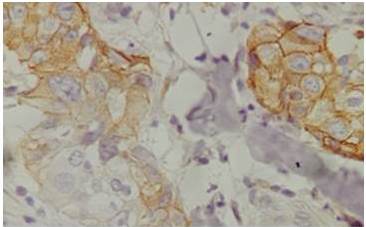 Inmuhistoquimica: E-cadherina 40X