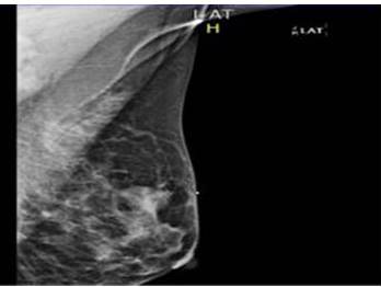 Proyeccin lateral de mamografia izquierda