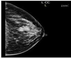 Proyeccin crneo caudal de mamografa izquierda