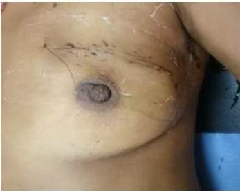 Resultado posoperatorio mediato de MPO y GC.