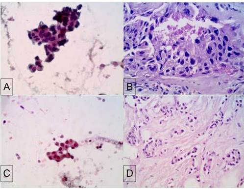 A) PAAF: Carcinoma ductal infiltrante, grado del tumor estimado 3. Se evidencian clulas ductales con aspecto pleomrfico, dispuestas en grupos e individuales, las clulas ductales muestran 5 veces el tamao de un eritrocito, envoltura nuclear angular e irregular, con cromatina condensada y nuclolo perceptible – 40x Papanicolaou. B) BAG: Carcinoma ductal infiltrante, grado histolgico 3 Las clulas ductales muestran marcada atipia nuclear (marcado pleomorfismo o anisonucleosis) – 40x H&E. C) PAAF: Carcinoma ductal infiltrante, grado del tumor estimado 1. Se evidencian clulas ductales con aspecto monomorfo, dispuestas en racimos, las clulas ductales muestran de 1-2 veces el tamao de un eritrocito, envoltura nuclear lisa, con cromatina vesiculosa y nuclolo indistinto – 40x Papanicolaou. D) BAG: Carcinoma ductal infiltrante, grado histolgico 1. En el campo histolgico se aprecia formacin de tbulos predominante y escaso pleomorfismo nuclear – 40x H&E.