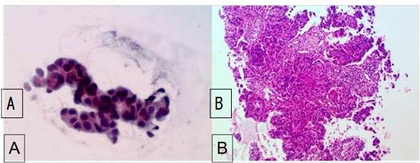 A) PAAF: carcinoma papilar infiltrante. Presencia de clulas ductales mostrando monomorfismo celular, con disposicin de aspecto papilar con acentuada atipia nucleares 40x Papanicolaou. B) BAG: carcinoma papilar infiltrante. Presencia de clulas ductales dispuestas en formacin papilar con eje fibrovascular, grado nuclear III – 10x H&E.