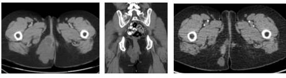RMN: izquierda corte axial y centro corte sagital previas a resecci�n parcial. Derecha: axial previa a cirugia definitiva