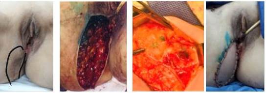 De izquierda a derecha: lesi�n y m�rgenes de resecci�n, defecto, ganglio centinela y reconstrucci�n