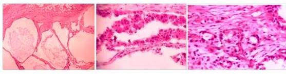 De izquierda a derecha: microquistes revestidos de epitelio columnar. Quistes con proyecciones papilares, nucleos hipercrom�ticos de tama�o y forma variables y c�lulas apicales con secreci�n por decapitaci�n. Gl�ndulas irregulares infiltrando el estroma denso, con n�cleos vesiculosos y nucleolos prominentes.