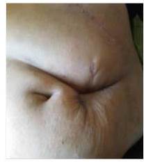 Cicatriz de herida quirúrgica.