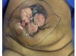 Lesión ulcerada en piel