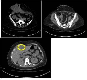 Metástasis hepática