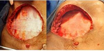 Malla de prolipopileno