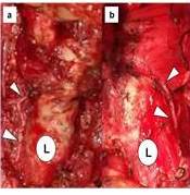 Identificacin intra-operatoria del trayecto del nervio larngeo recurrente. Puntas de flecha blanca sealan la estructura nerviosa. Letra “L” en circulo blanco indicando la laringe.