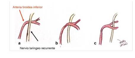 Clasificacin de la relacin entre la arteria tiroidea inferior y el nervio larngeo recurrente. a) Superficial. b) Profundo. c) Entre las ramas.