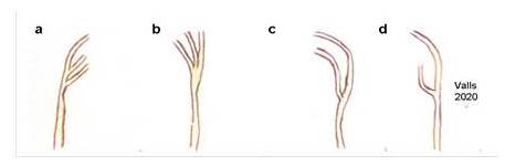 Esquema de divisiones extralarngeas del nervio larngeo recurrente en cuatro pacientes sometidos a lobectomas tiroideas. Todos en ubicacin profunda respecto a la arteria tiroidea inferior. Se constatan divisiones de dos y tres  ramas.