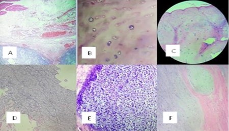 A: borde de resecci�n profundo con l�bulos de neoplasia condroide. B: �reas de lesi�n hipo celulares, con escaso pleomorfismo. C: incremento moderado de la celularidad. D: mayor hiper celularidad, con escaso pleomorfismo, sin figuras mit�ticas. D: focos de c�lulas pleom�rficas, de n�cleos hipercr�micas con atipias marcadas. F: nidos de neoplasia bien diferenciada, infiltrando el tejido subcut�neo.