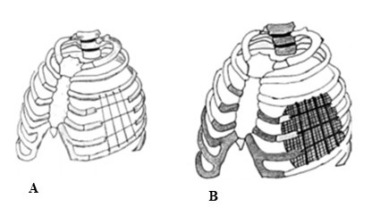 A. Estabilizaci�n de la pared tor�cica con la t�cnica de Leininger. B. Estabilizaci�n de la pared tor�cica con la t�cnica de Leininger e interposici�n de malla