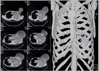 TAC de t�rax con contraste y reconstrucci�n 3D 2019: lesi�n voluminosa, de crecimiento expansivo, que rompe la cortical, se extiende a la mama izquierda, cavidad tor�cica y mediastino izquierdo