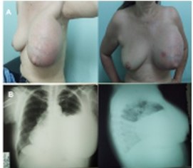 A: Vista frontal y lateral de mama izquierda con masa gigante de 30 cm x 20 cm, de consistencia indurada, con red venosa colateral. B: Radiolog�a simple AP y lateral izquierdo donde se observa un velamiento extenso de los 2/3 inferiores del campo pulmonar izquierdo, con derrame pleural.