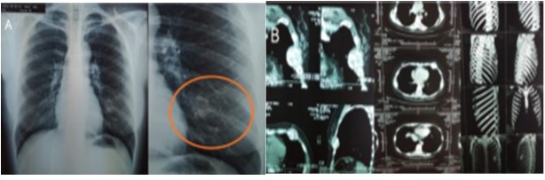 RX de t�rax AP y TAC de t�rax contrastado y reconstrucci�n 3D 2012. A. Se evidencia cambios en la densidad y ruptura de la cortical del 5o arco costal anterior izquierdo. B. Presencia de masa expansiva, l�tica de 4 cm x 5 cm en quinto arco costal anterior izquierdo.