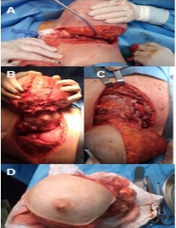 A: mastectom�a tipo Halsted no radical. B: resecci�n del tercer, cuarto y quinto arcos costales izquierdos. Se observa desplazamiento del pulm�n. C: tumor desplazando el pericardio (Flecha). D: pieza definitiva.